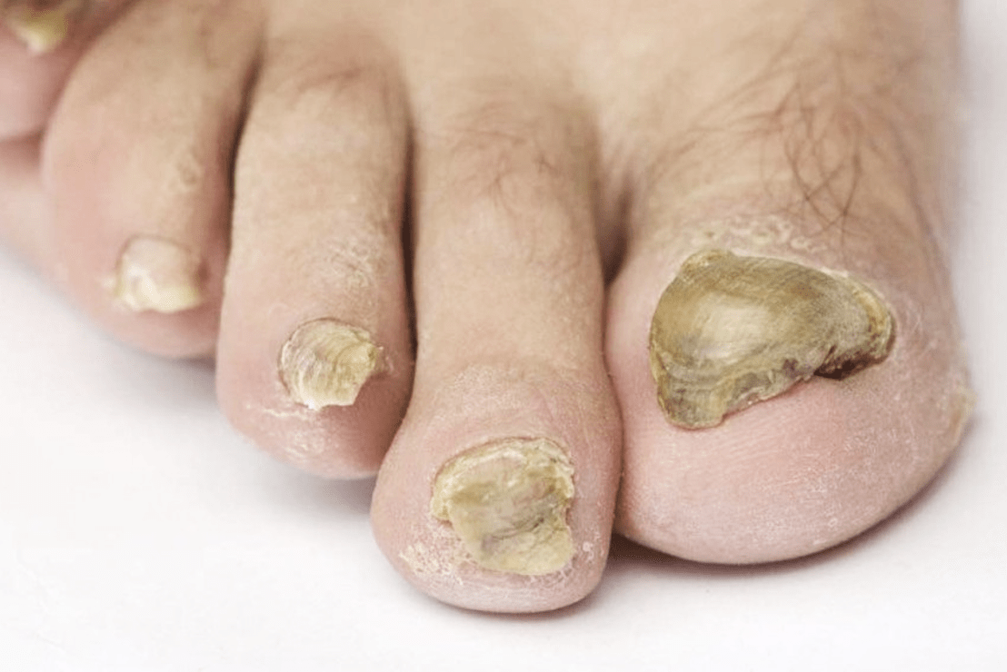 mantarlı tırnak-ayak bakımı