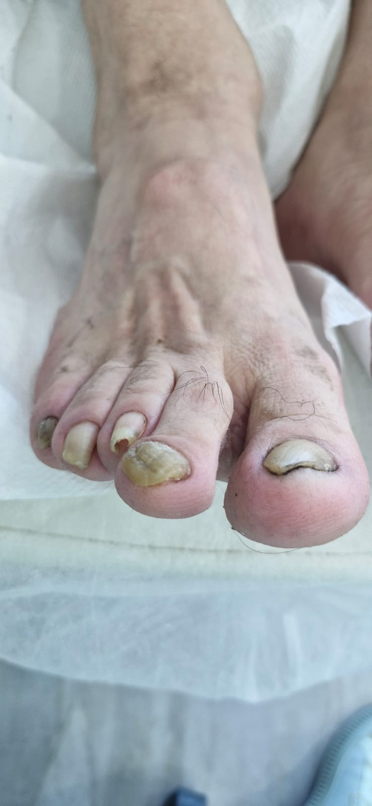 Kalınlaşmış Tırnak